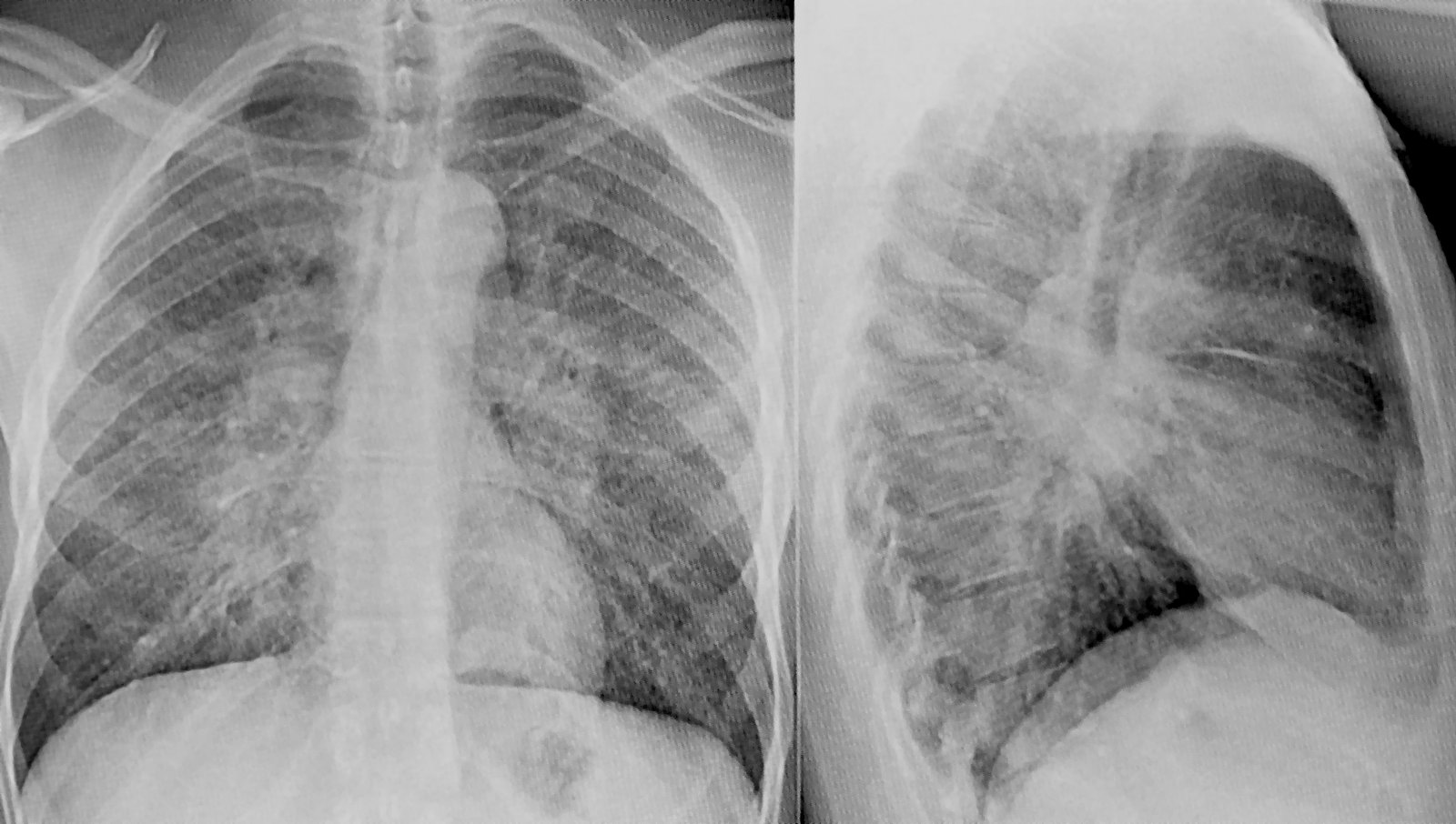 Sarcoidosis - Knowledge @ AMBOSS