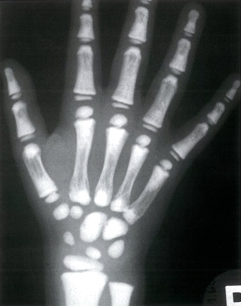 Achondroplasia X Ray Hand