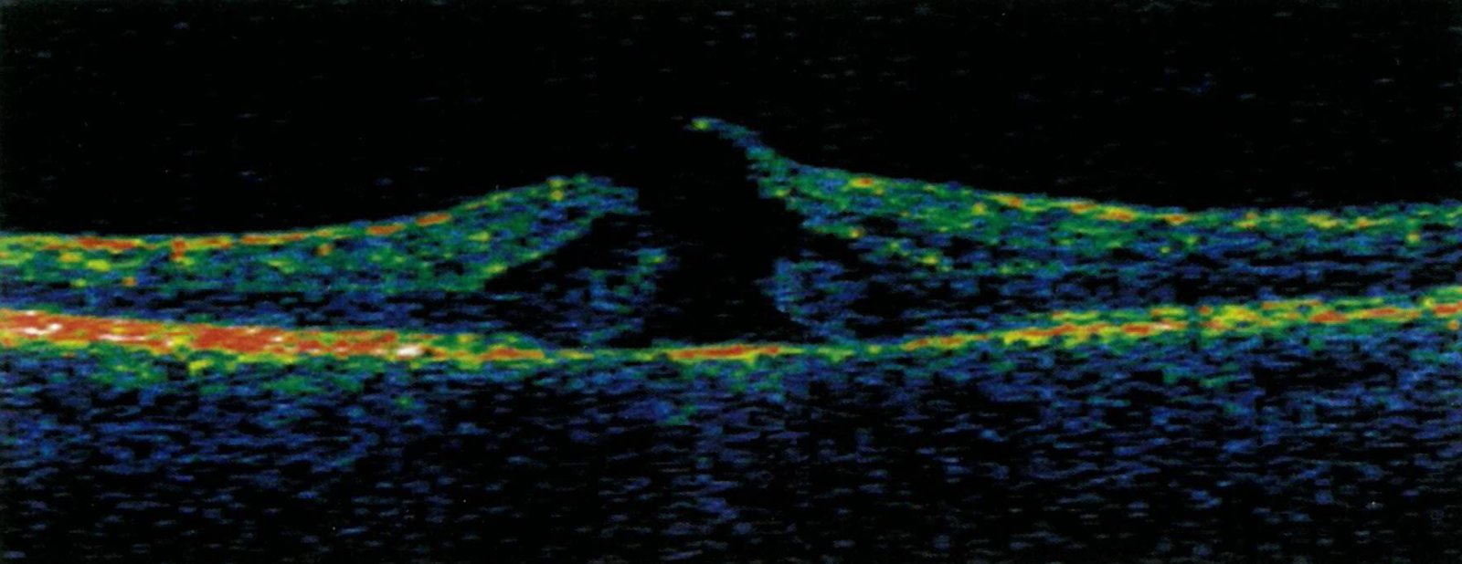 Diseases Of The Retina Amboss