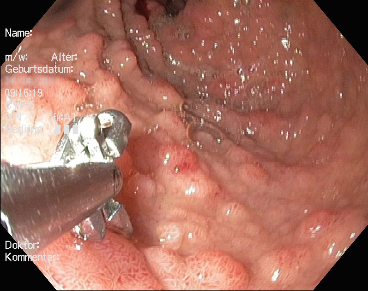colorectal cancer amboss