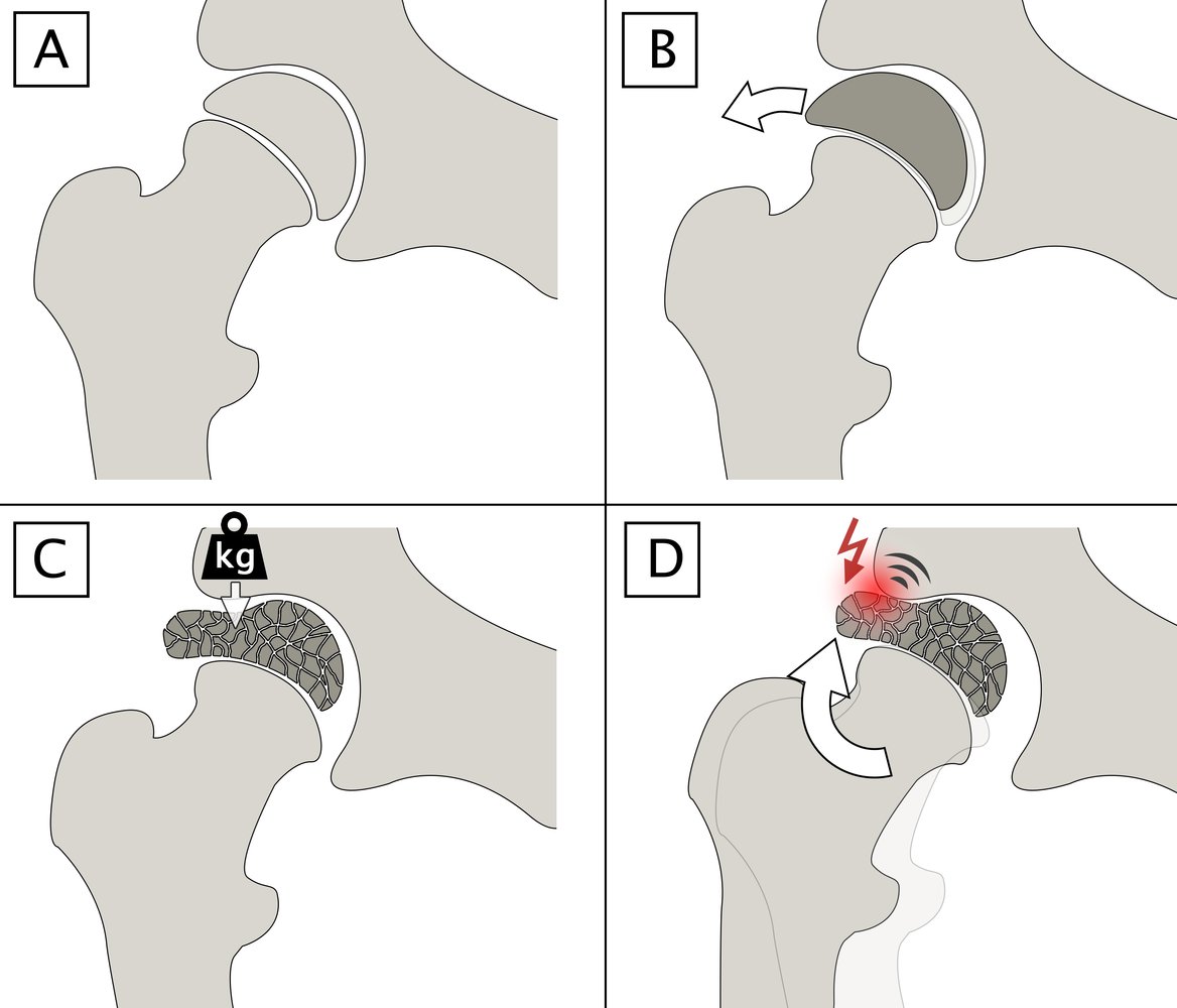 Legg-Calve-Perthes Braces | PrimeCare, image size:1168x1000