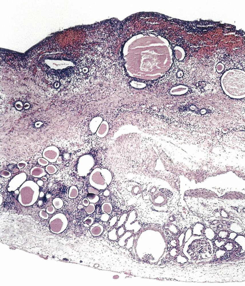 Renal Papillary Necrosis Histology