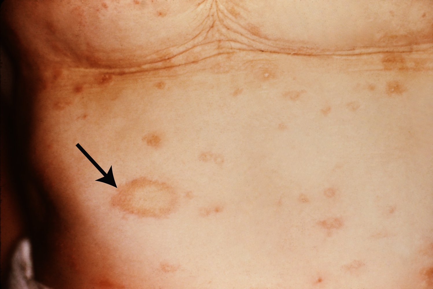 Mild Pityriasis Rosea