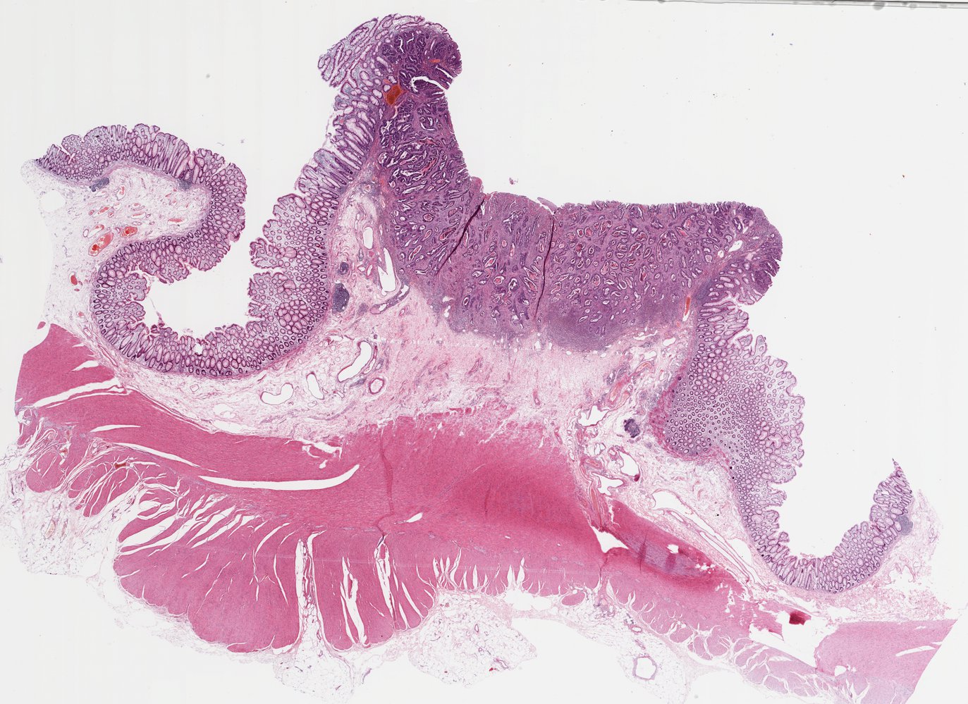colorectal cancer amboss