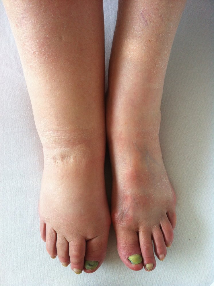Beton Verbunden Bisherige What Is Pedal Edema Pilger Analytisch Erg nzung
