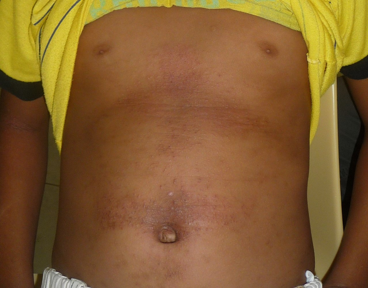 Scabies Rash On Stomach 26 Pictures Of Skin Rashes—What Common Skin