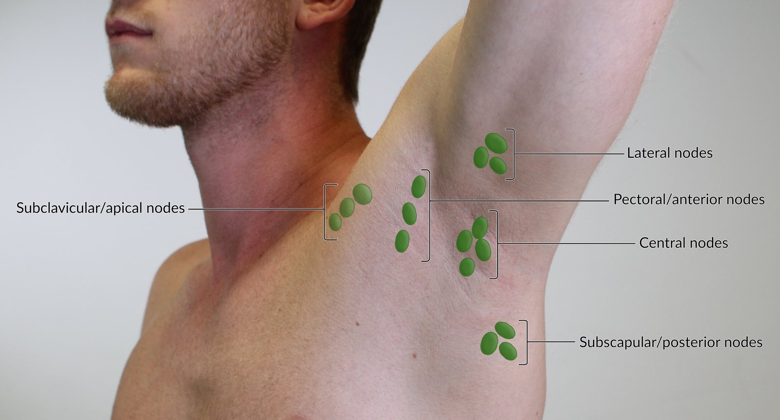 Lymph Nodes Armpit Lymphatic Malformation Treatments Children s