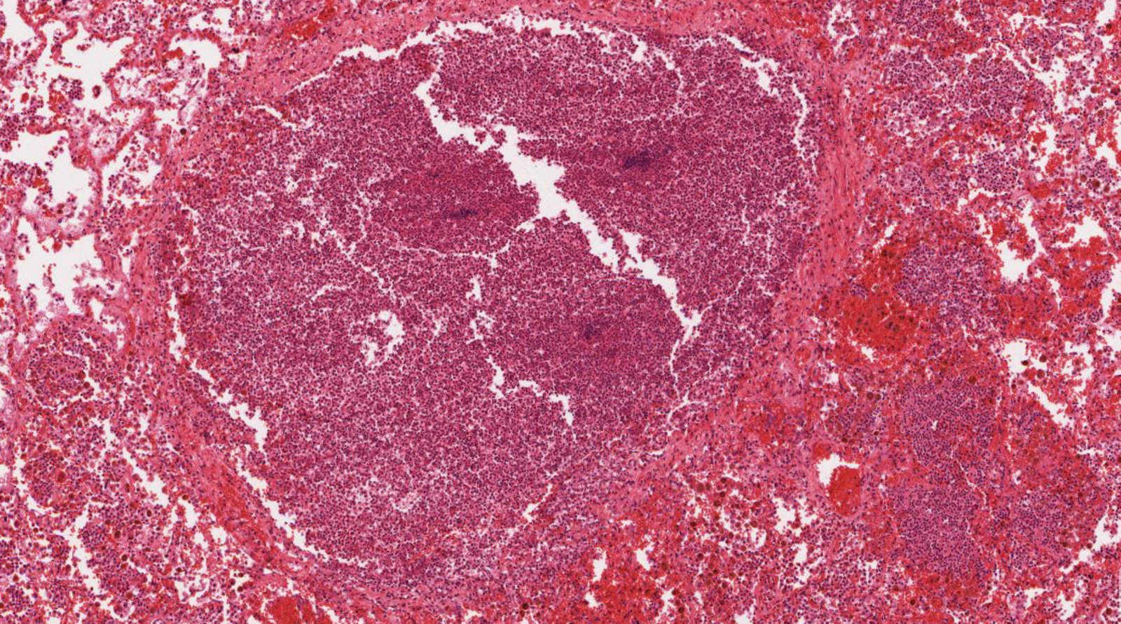 Pneumonia - Knowledge @ AMBOSS