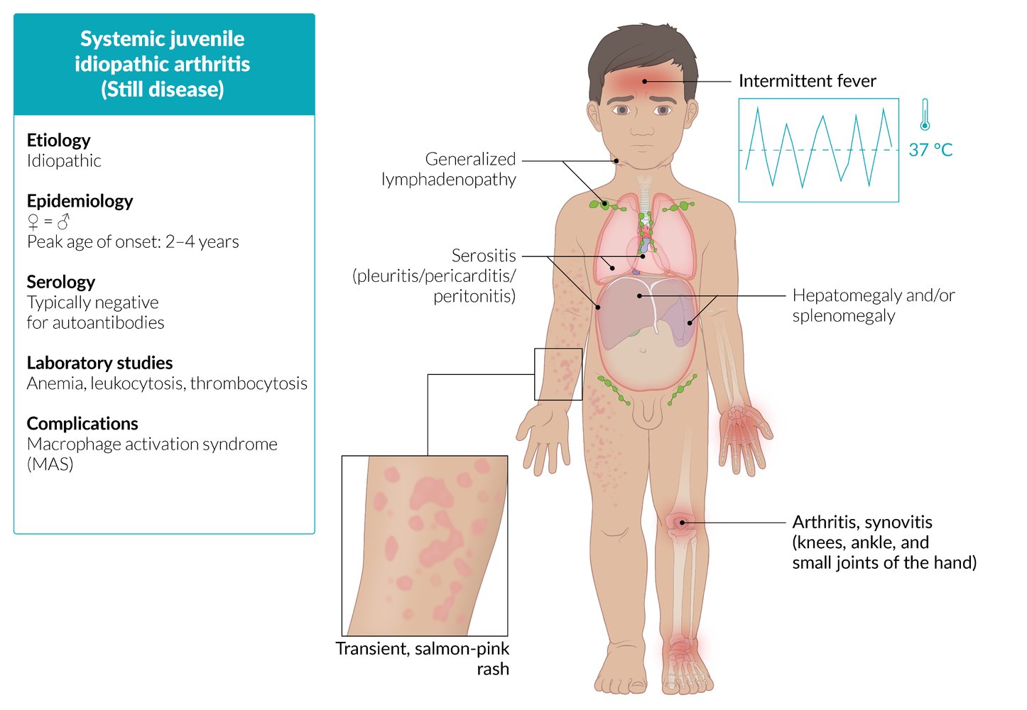 juvenile idiopathic arthritis symptoms tratamentul preparatelor articulare