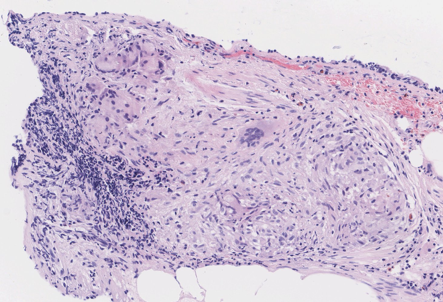 Sarcoidosis - Knowledge @ AMBOSS
