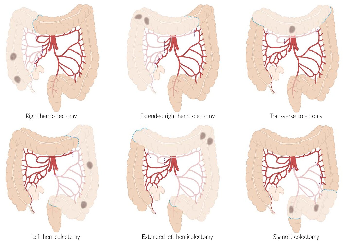 colorectal cancer amboss
