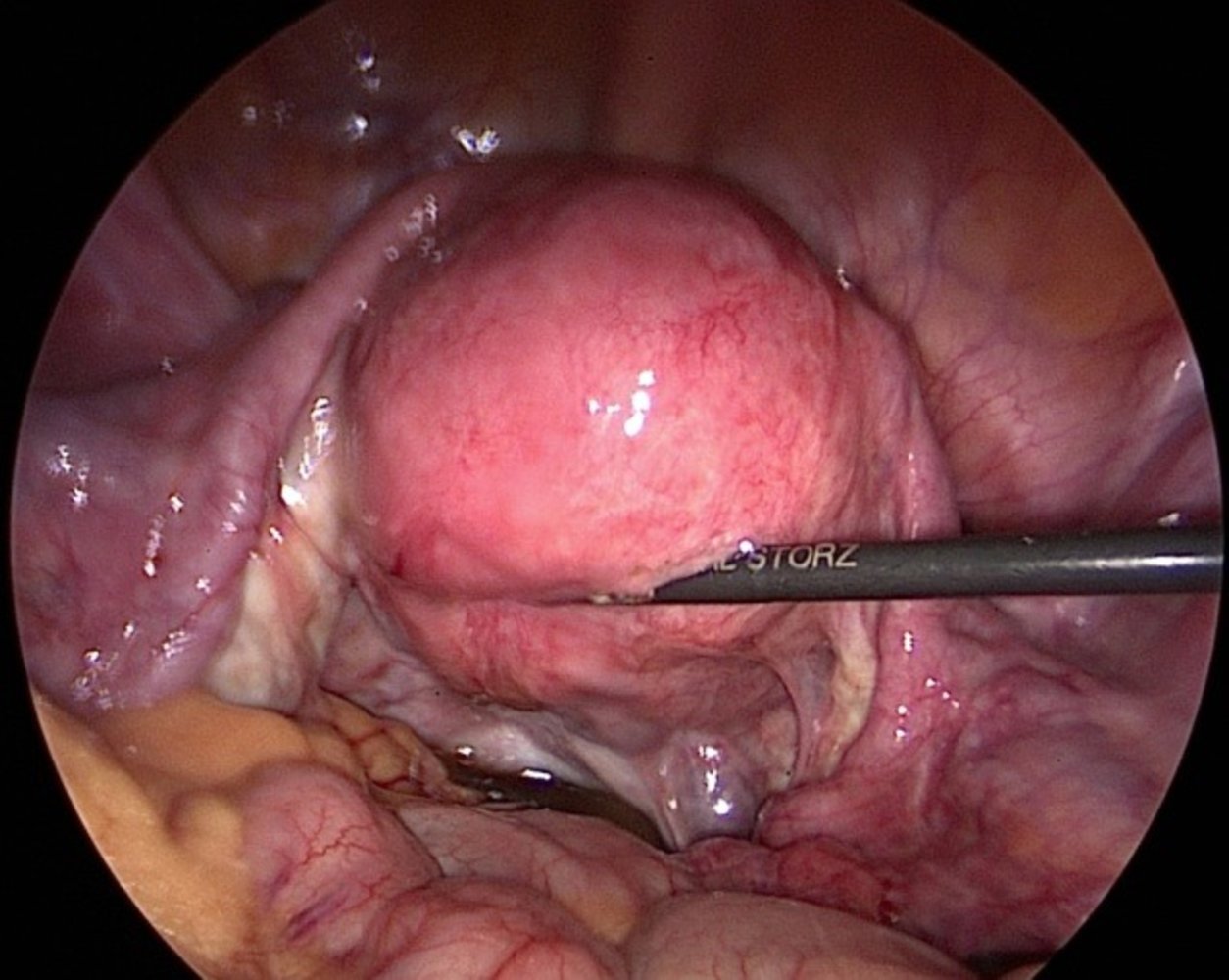 Female reproductive organs - Knowledge @ AMBOSS
