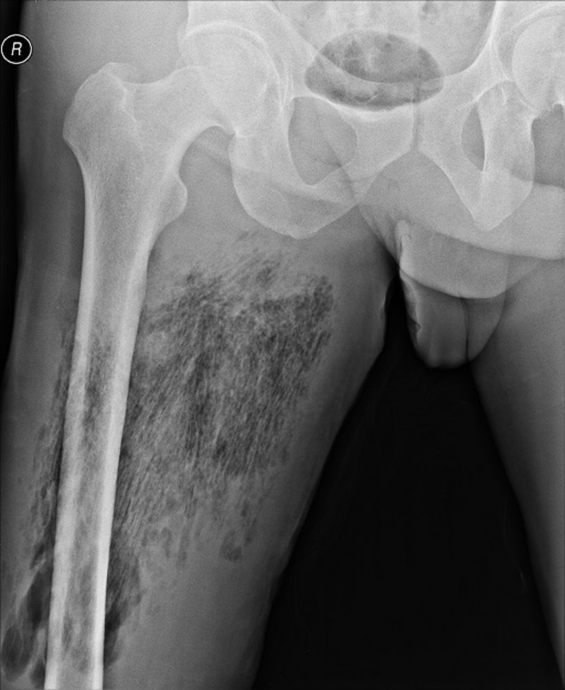 A review of the development of gangrene in patients with systemic lupus  erythematosus – A 44-year follow-up study - Joana Rua, David Isenberg, 2023, image size:819x1000