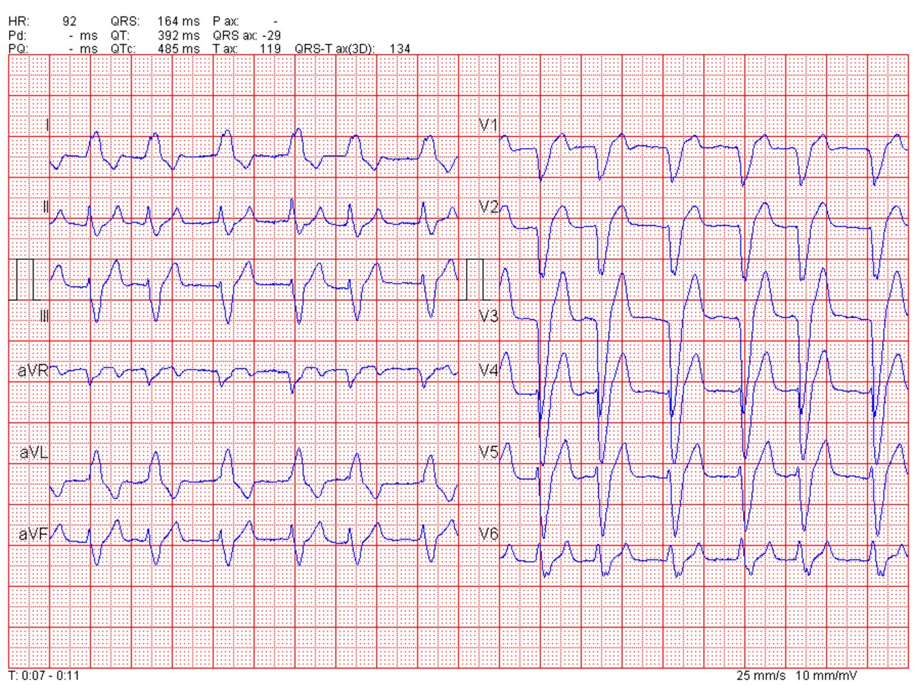 Atrial Fibrillation Knowledge Amboss