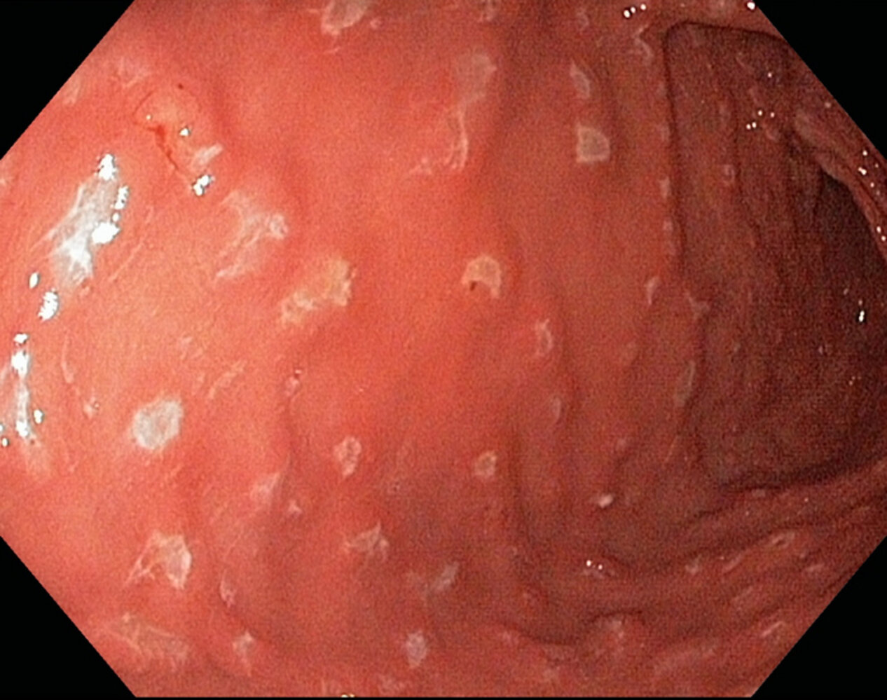 elfbar elfa master akku Gastritis: Causes, Symptoms, Diagnosis and Treatment main image 0
