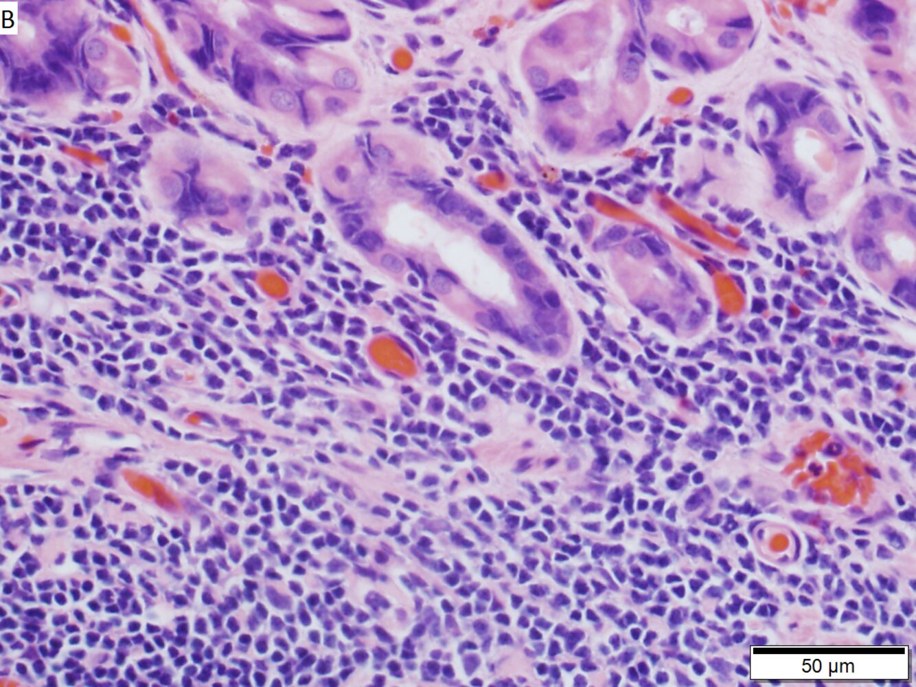 Extranodal Marginal Zone Lymphoma