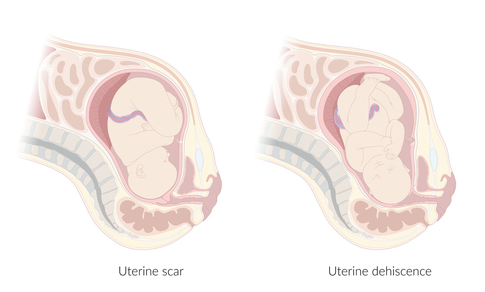 Uterine Rupture Uterine Rupture During Labor | Doctor Stock