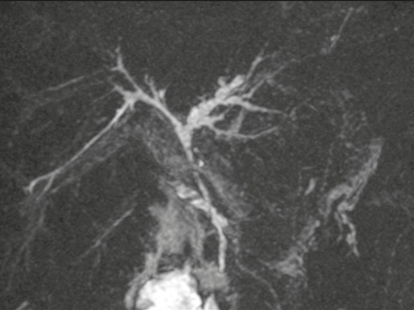 sclerosing cholangitis bpc 157 Primary sclerosing cholangitis