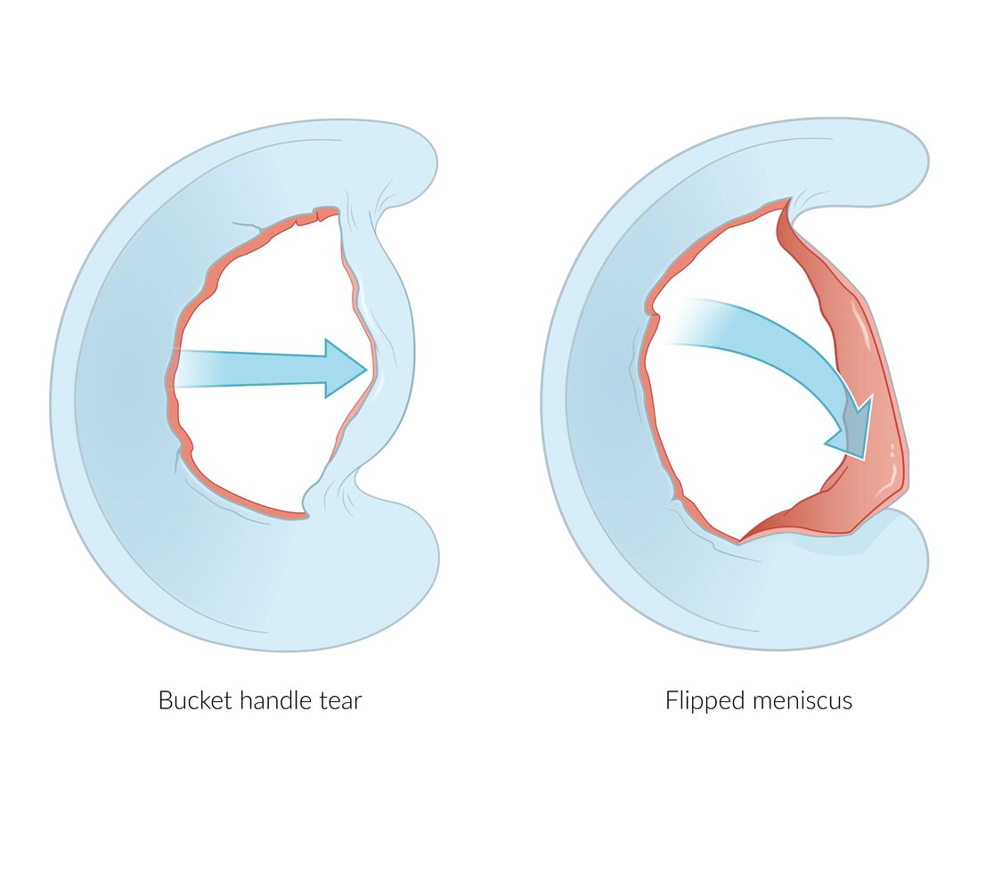 Does A Bucket Handle Meniscus Tear Need Surgery At James Gamble Blog