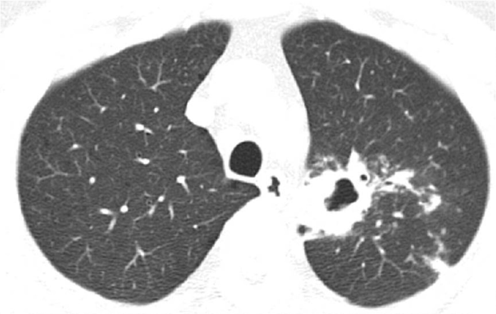 Tuberculosis<!-- --> - <!-- -->Knowledge<!-- --> @ AMBOSS
