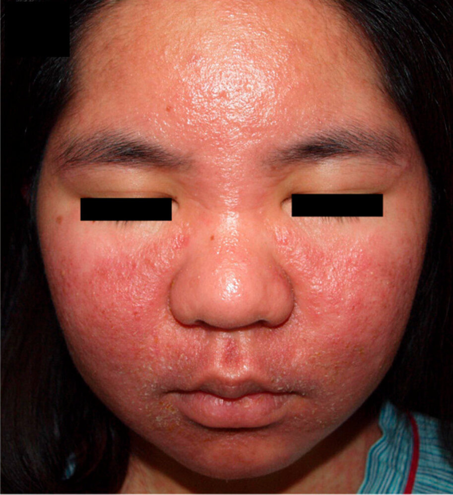 Drug Reaction With Eosinophilia And Systemic Symptoms