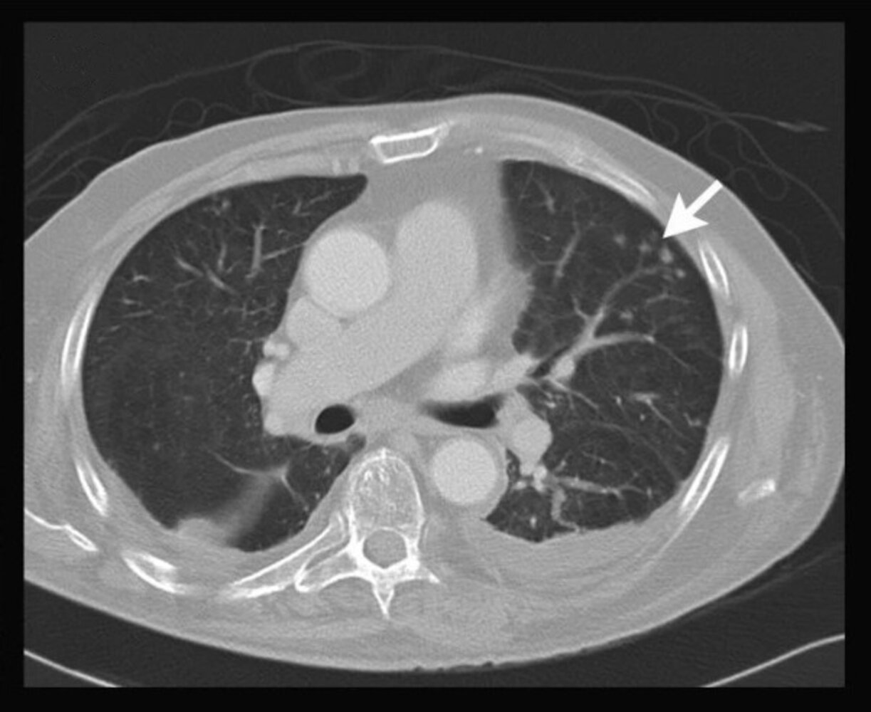 Tuberculosis - Knowledge @ AMBOSS