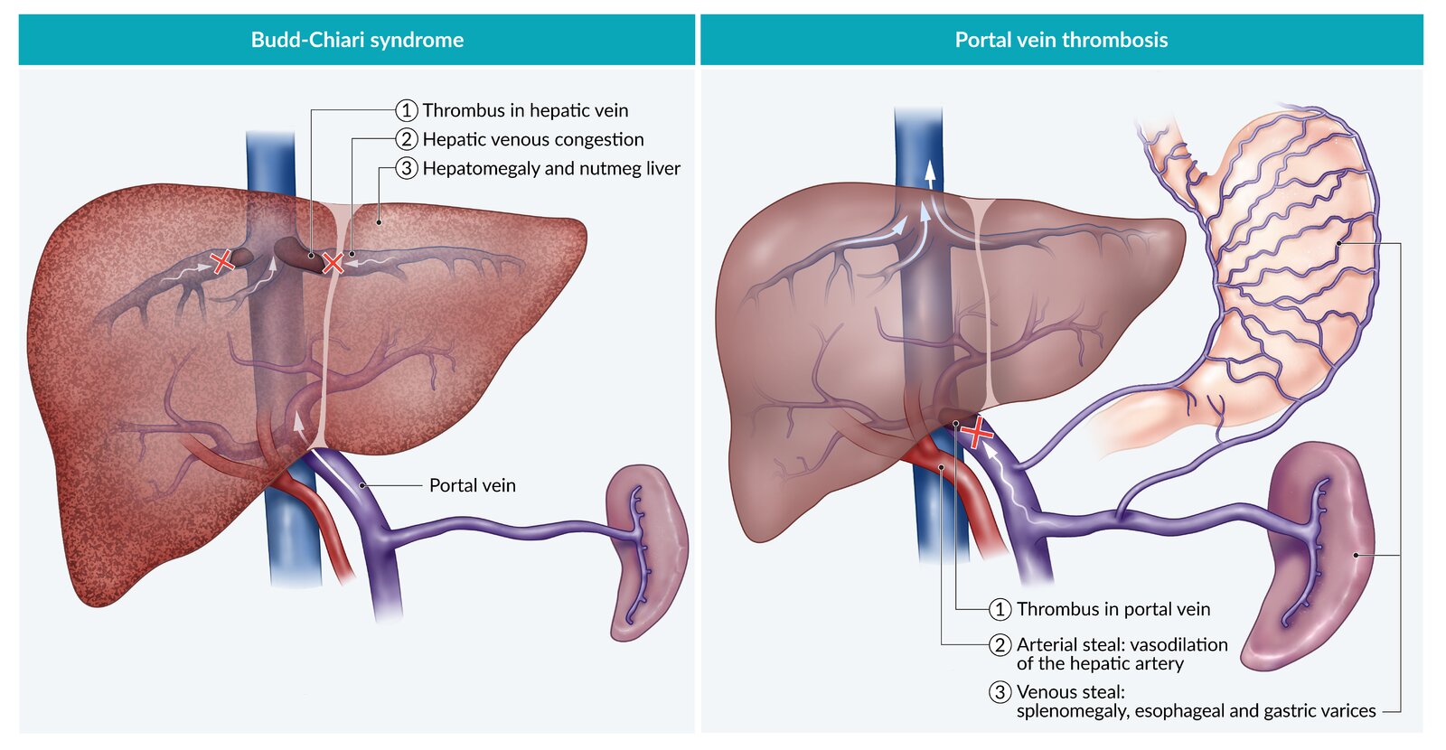 Budd Chiari Syndrome Hepatic Vein Thrombosis DIPS 49 OFF