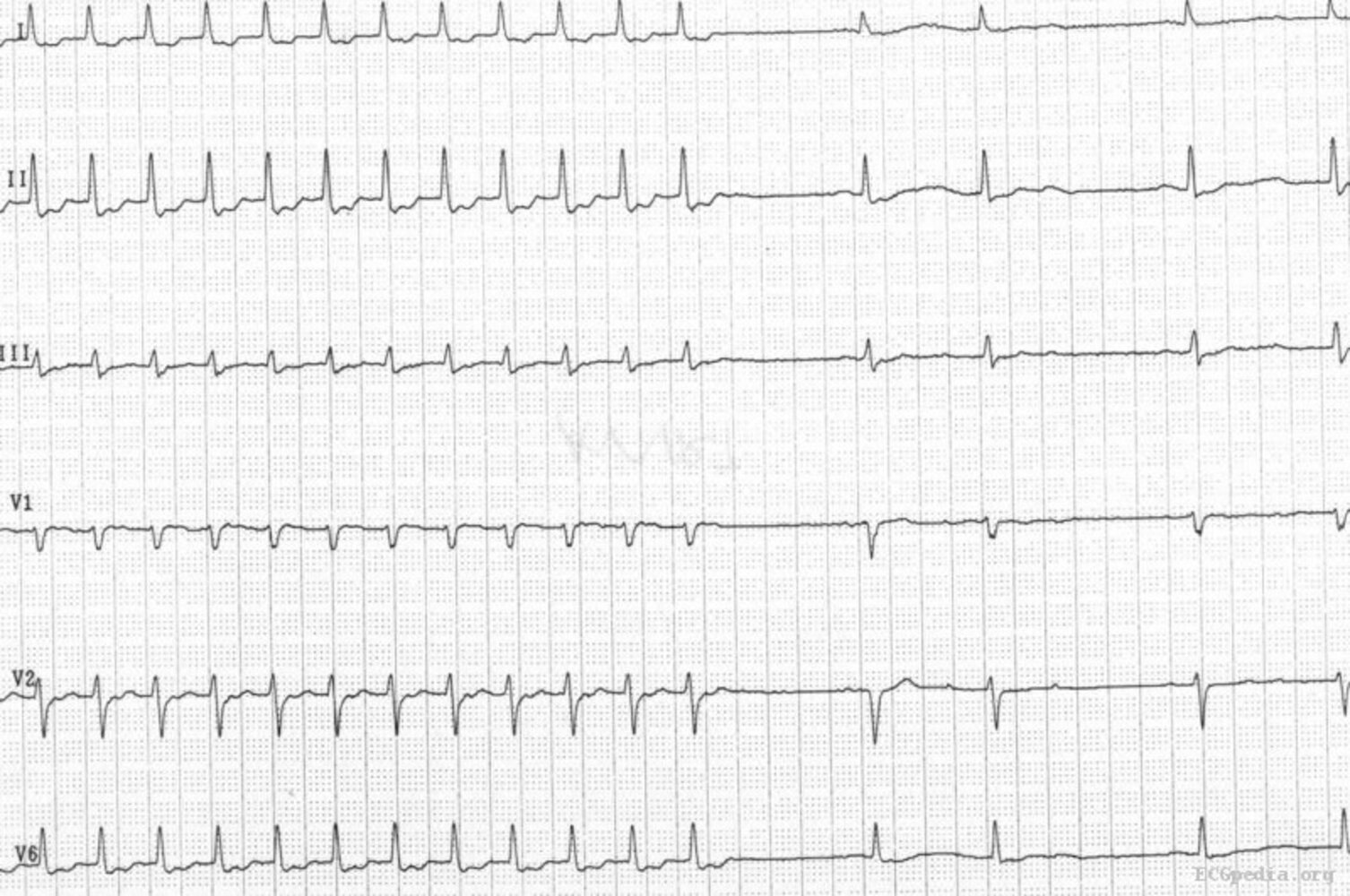 What Is Av Nodal Reentrant Tachycardia