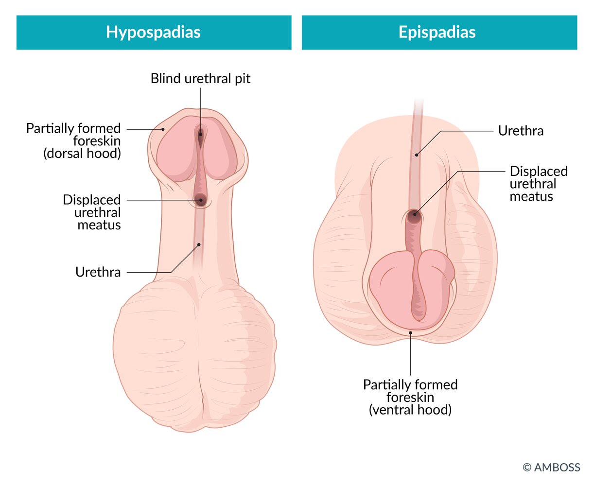 Hypospadias, image size:1222x1000