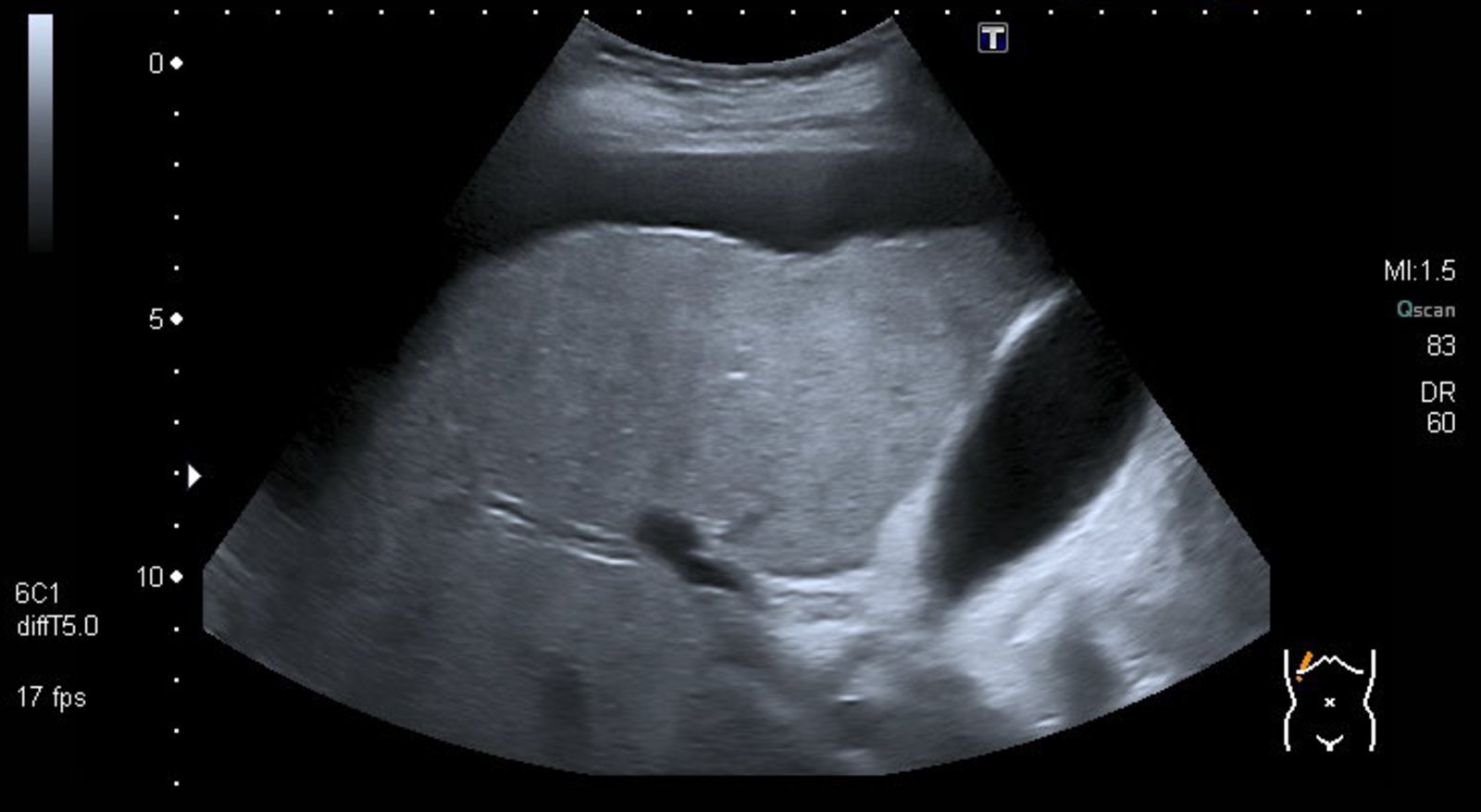 Cirrhosis Liver Ultrasound