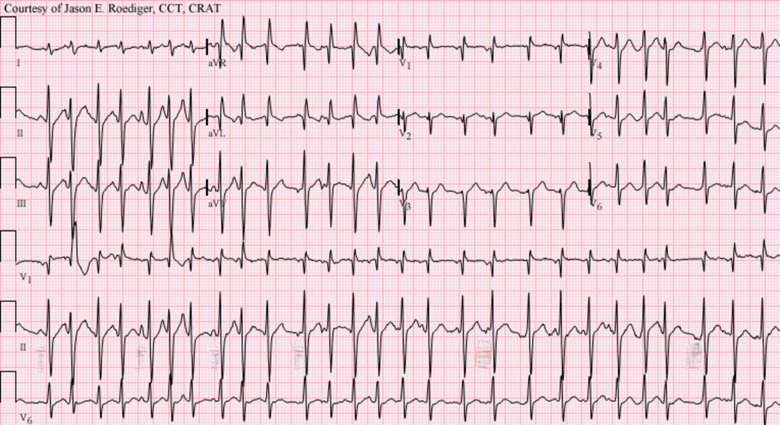 Supraventricular tachycardia - Knowledge @ AMBOSS, image size:1600x872