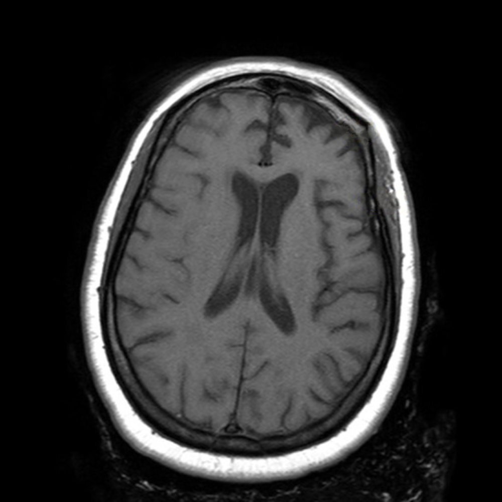 Major neurocognitive disorder - Knowledge @ AMBOSS