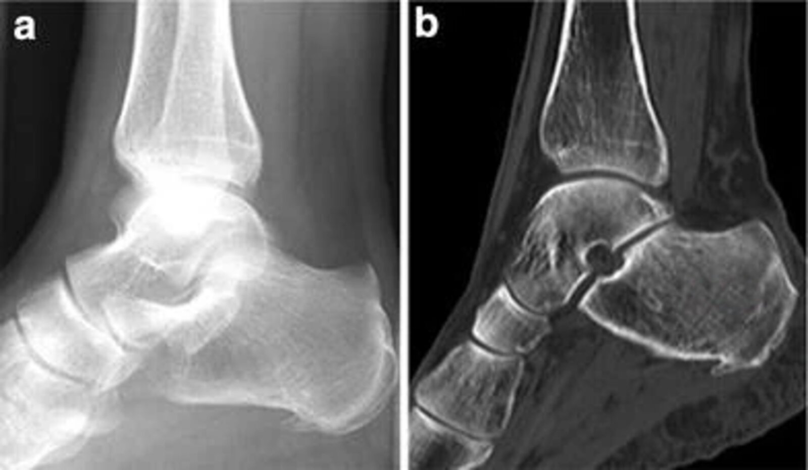 Stress Fracture Tibia Ankle
