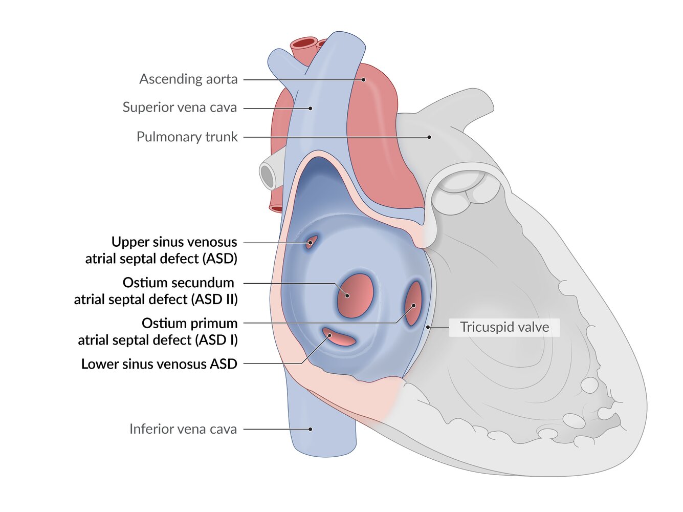 cyanosis様 Acyanotic congenital heart defects - Knowledge @ AMBOSS