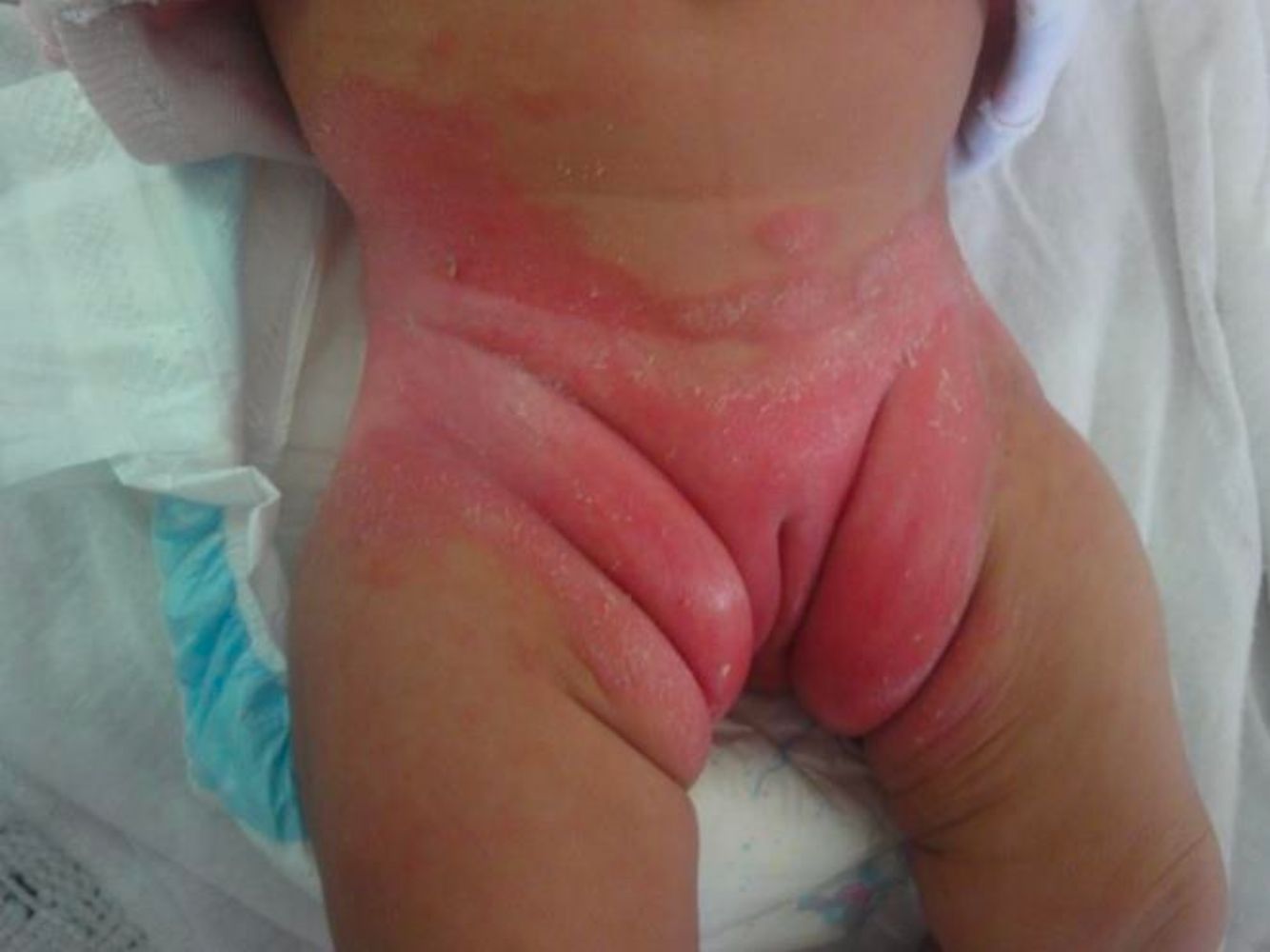 Amoxicillin Cause Diaper Rash