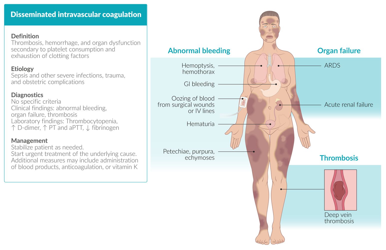 Disseminated Intravascular Coagulation Criteria