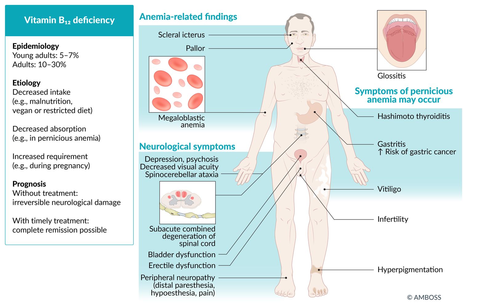 What Is Vitamin B12 Deficiency Pernicious Anemia