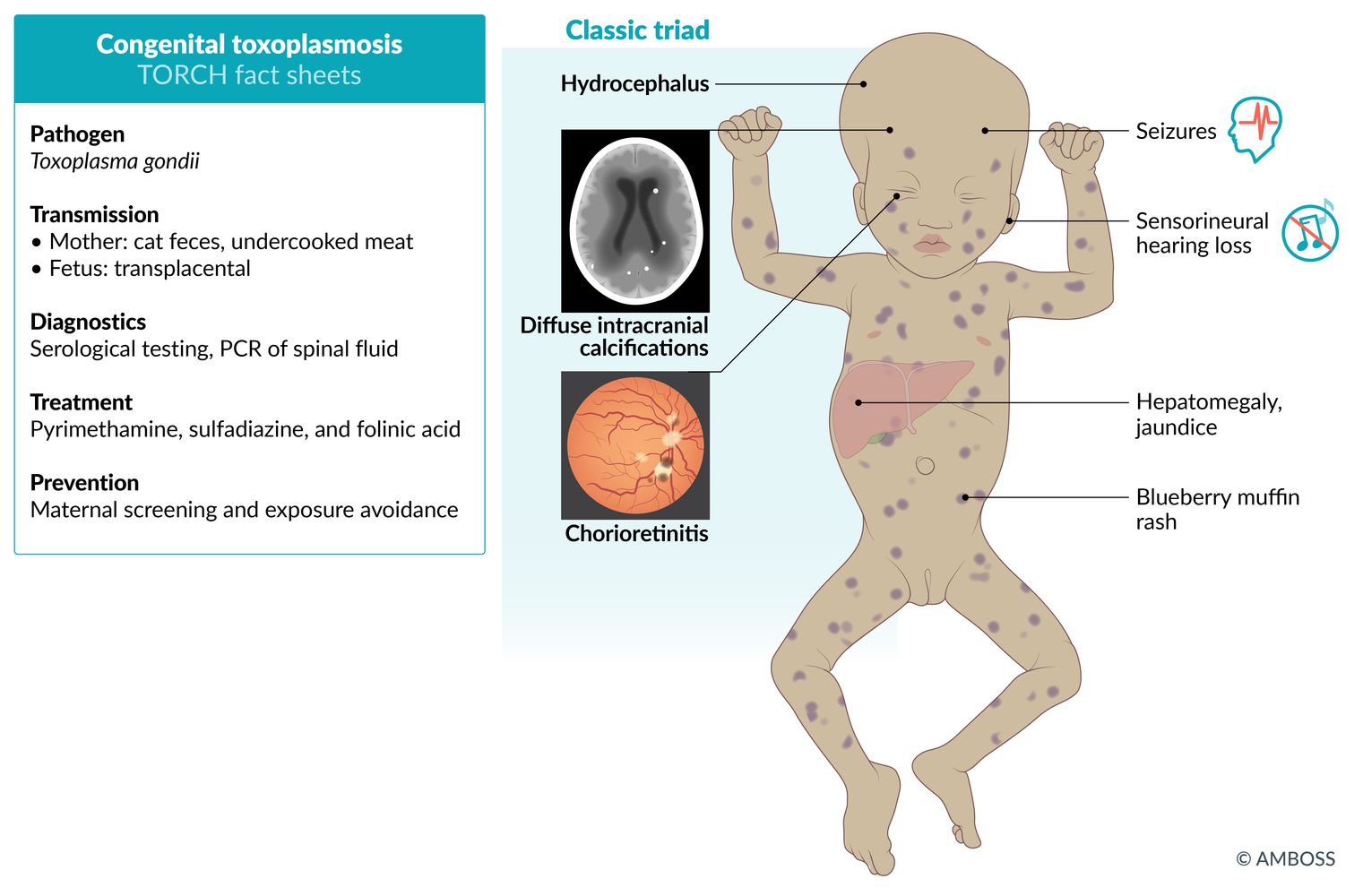 Congenital Toxoplasmosis Rash Torch Syndrome (Chronic Congenital