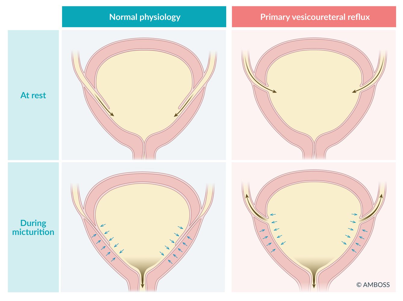 Vesicoureteral Reflux Surgery