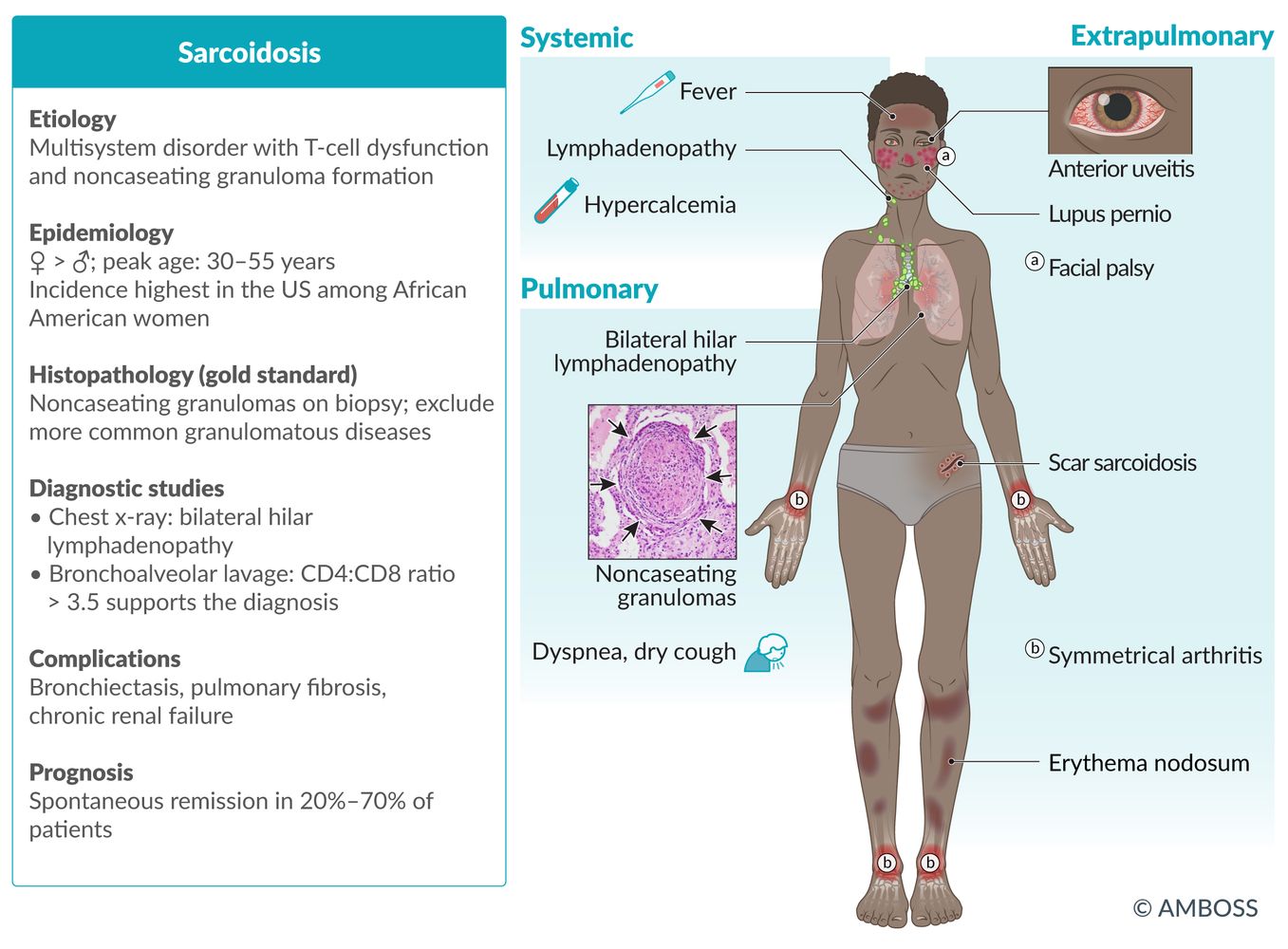 Sarcoidosis - Knowledge @ AMBOSS
