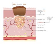 Delayed wound healing