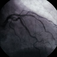 Percutaneous coronary intervention ( PCI )/ percutaneous transluminal ...