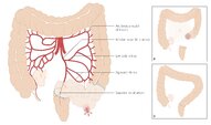 Stoma ( enterostomy , artificial bowel outlet , artificial anus ) [1]