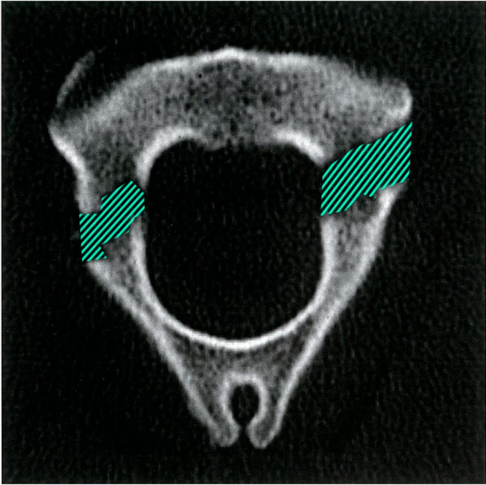 Fractures of the C-2 vertebral body in: Journal of Neurosurgery Volume 81  Issue 2 (1994) Journals, image size:1002x1000