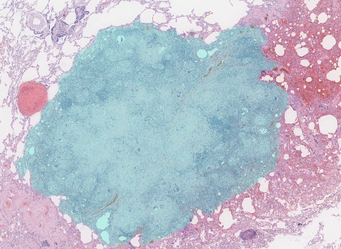 Sarcoidosis - Knowledge @ AMBOSS