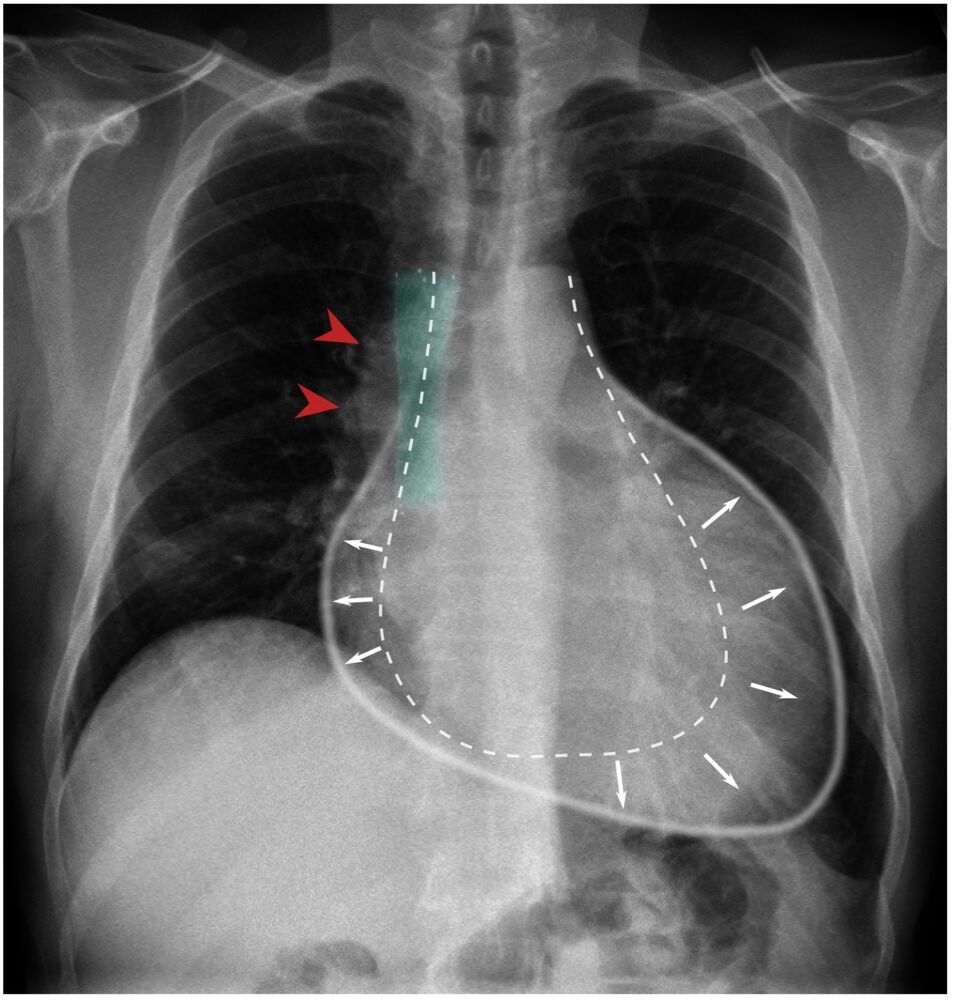 Pericardial Effusion X Ray Pericardial Effusion RadRounds Radiology