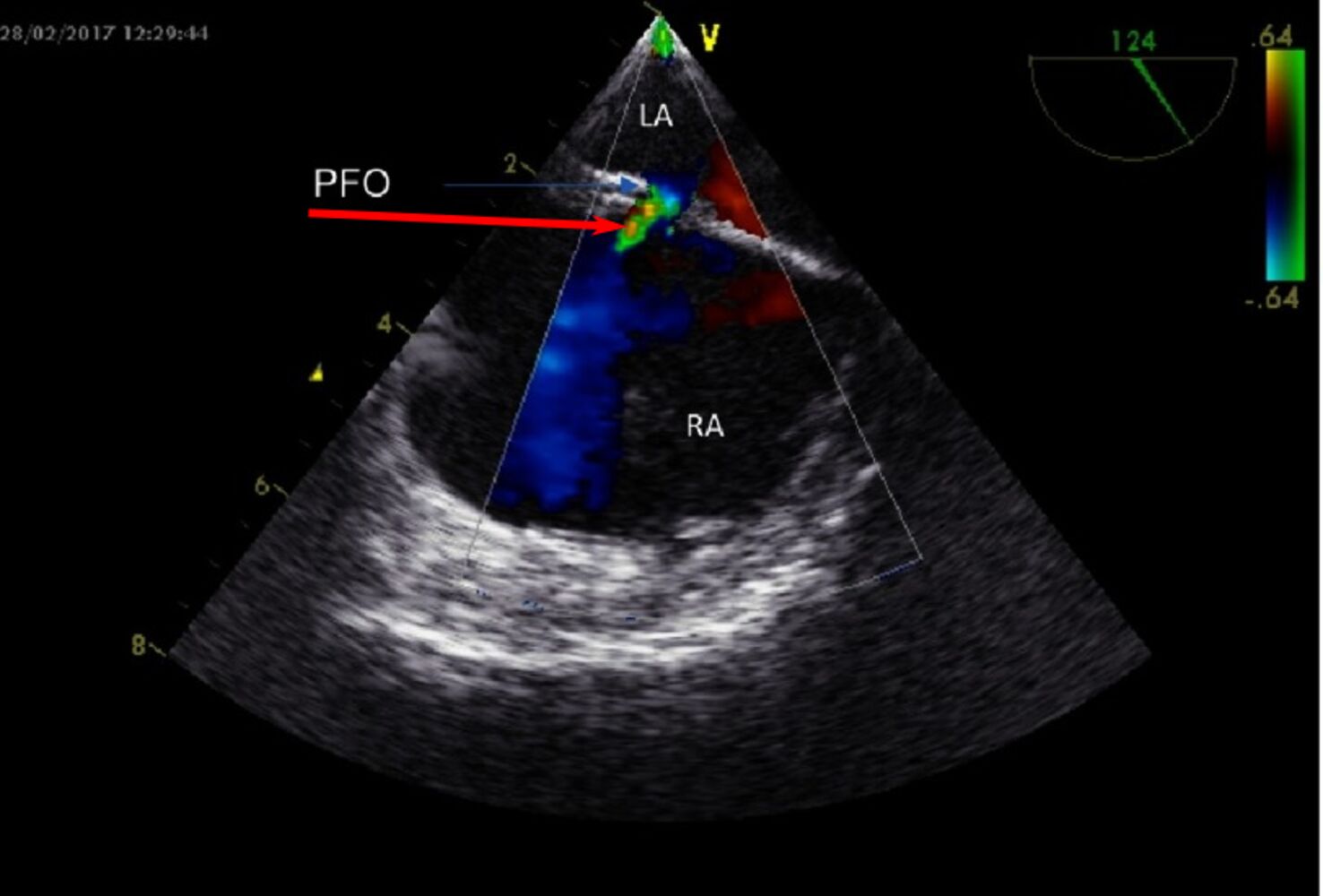 Acyanotic congenital heart defects - Knowledge @ AMBOSS