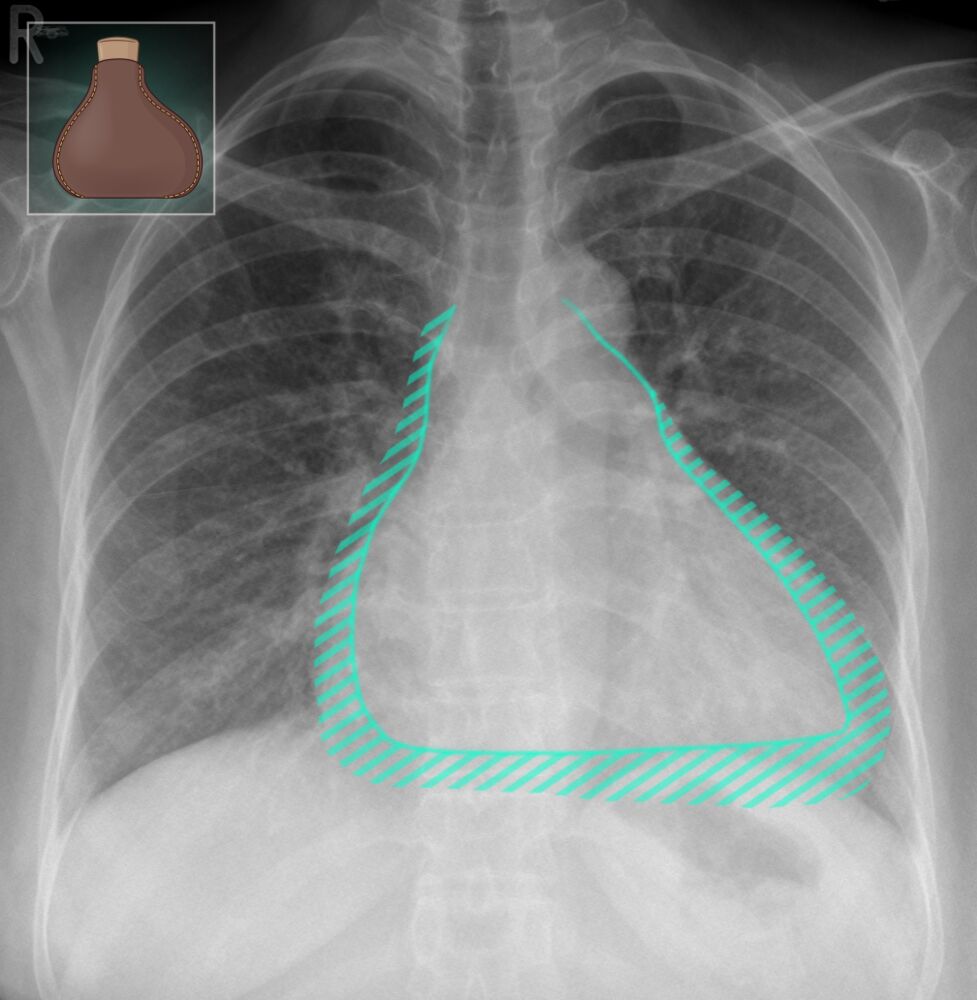 Chest X Ray Cardiac Disease Pleural Effusions Nbkomputerdecubitus 
