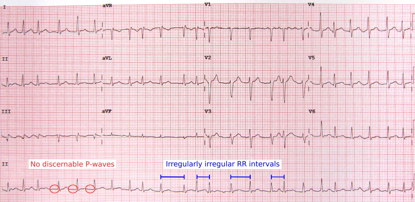 What Are The Five Basic Types Of Arrhythmias Infoupdate