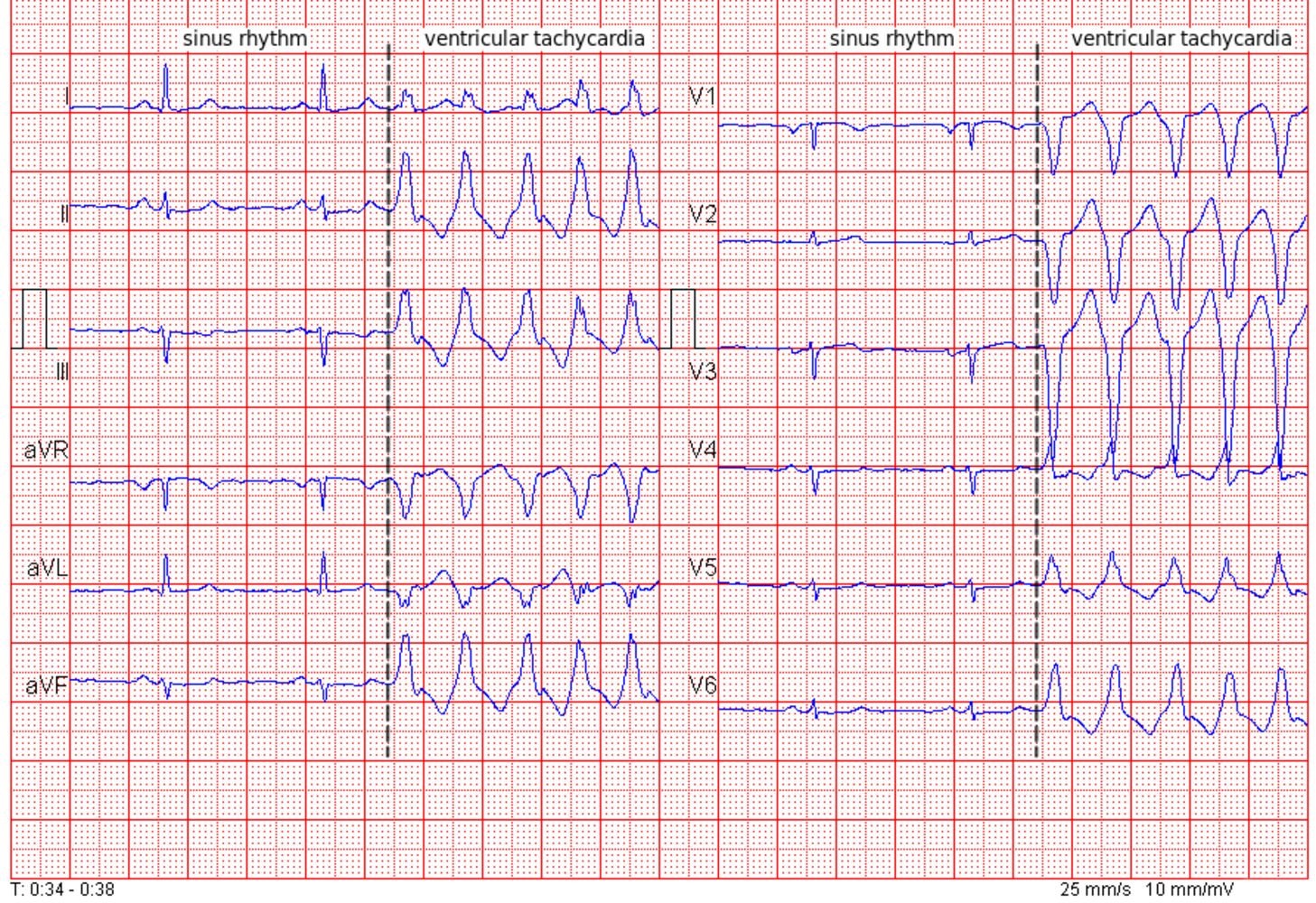 Taquicardia Ventricular Ecg Ventricular Tachycardia And In Hospital